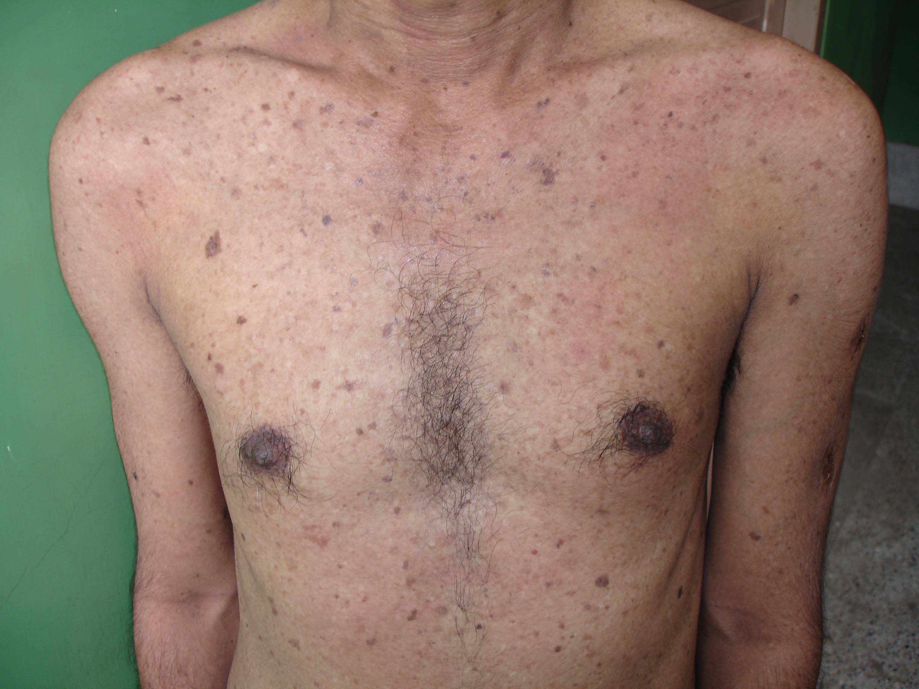 2011.17.Eponyms Acd Our Dermatology Online